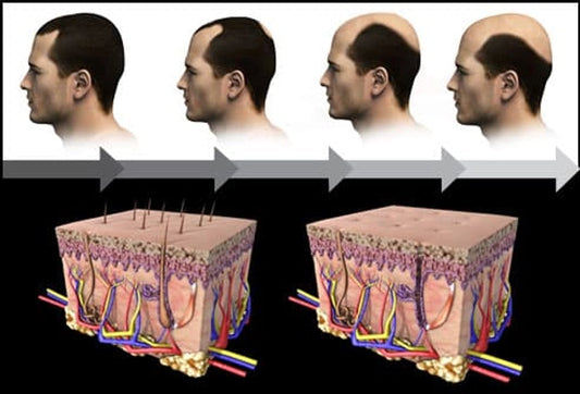 Topical finasteride for male and female pattern hair loss: Is it a safe and effective alternative?