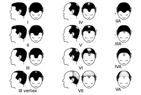 Comparing the effectiveness and safety of 0.25% finasteride mixed with 3% minoxidil local solution and 3% minoxidil solution in the treatment of male androgenic alopecia, which one is better